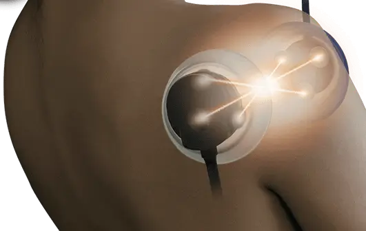 特殊電流刺激治療器
